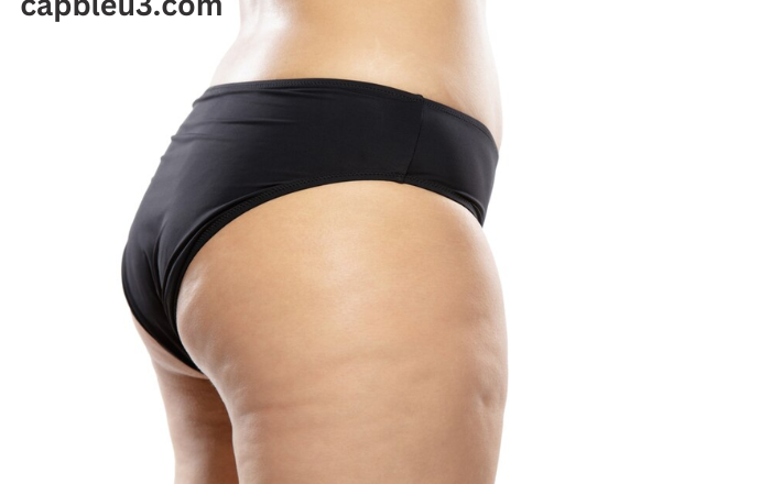 Proven Cellulite Reduction Treatments: Get Smooth, Toned Skin Today